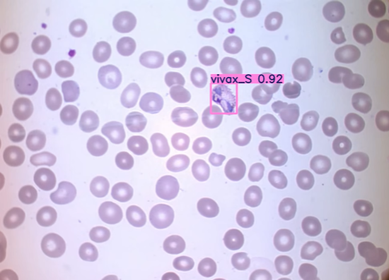 Automated Malaria Detection: CDC Guidelines, Malaria Parasite & AI